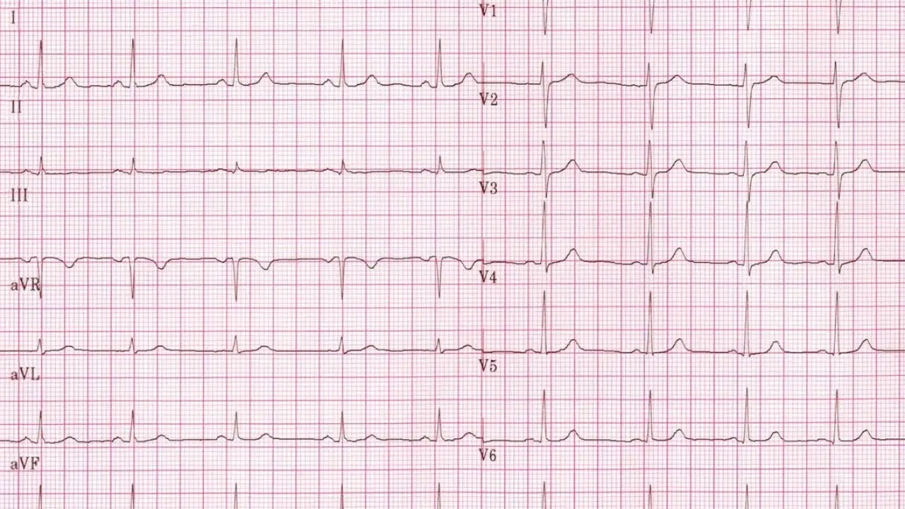 What is normal on an EKG?